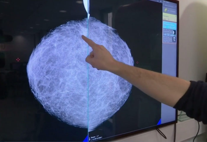 Startup francesa interpreta mamografias através de redes de neurônios