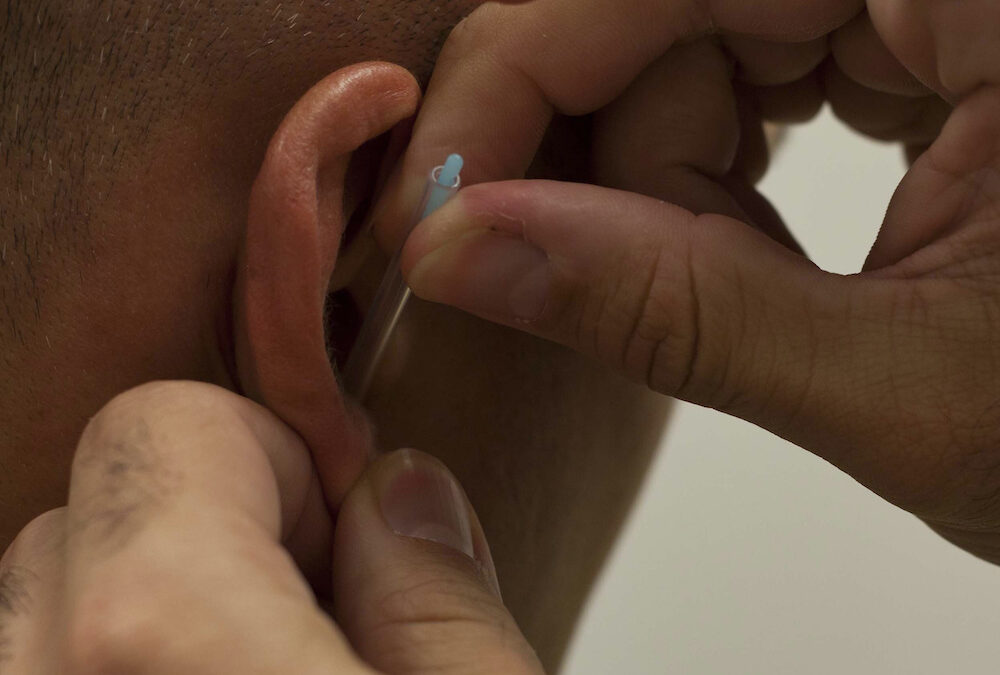 Estudo confirma benefício da acupuntura auricular no tratamento da depressão